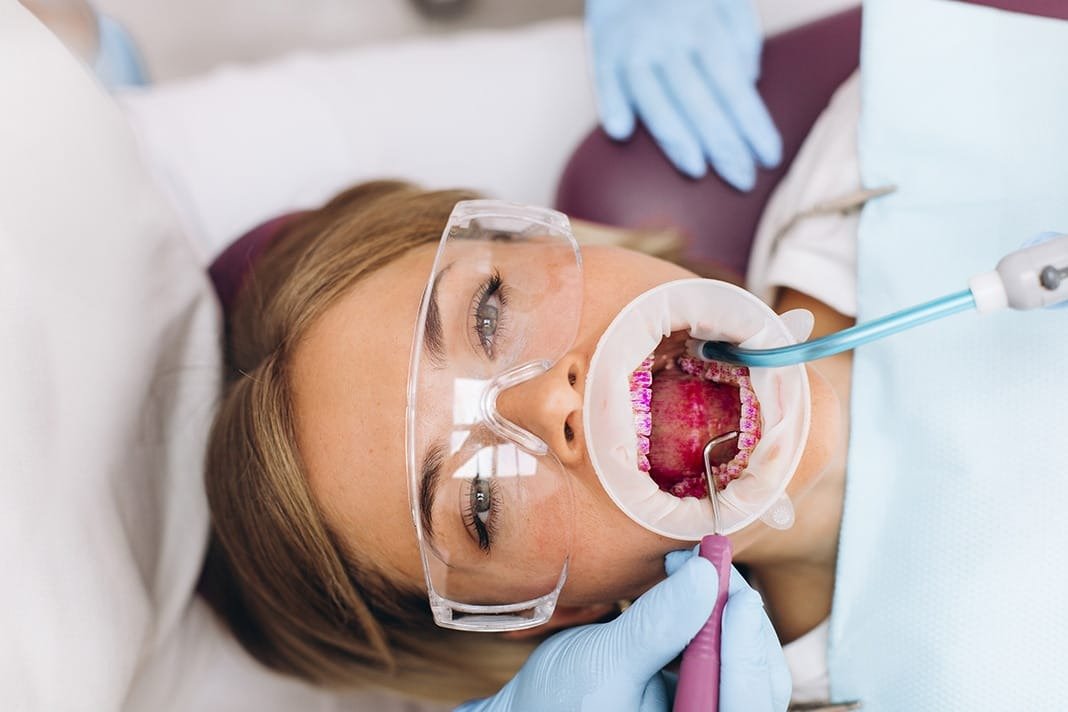 Guided Biofilm Therapy A Modern Approach to Cleanings